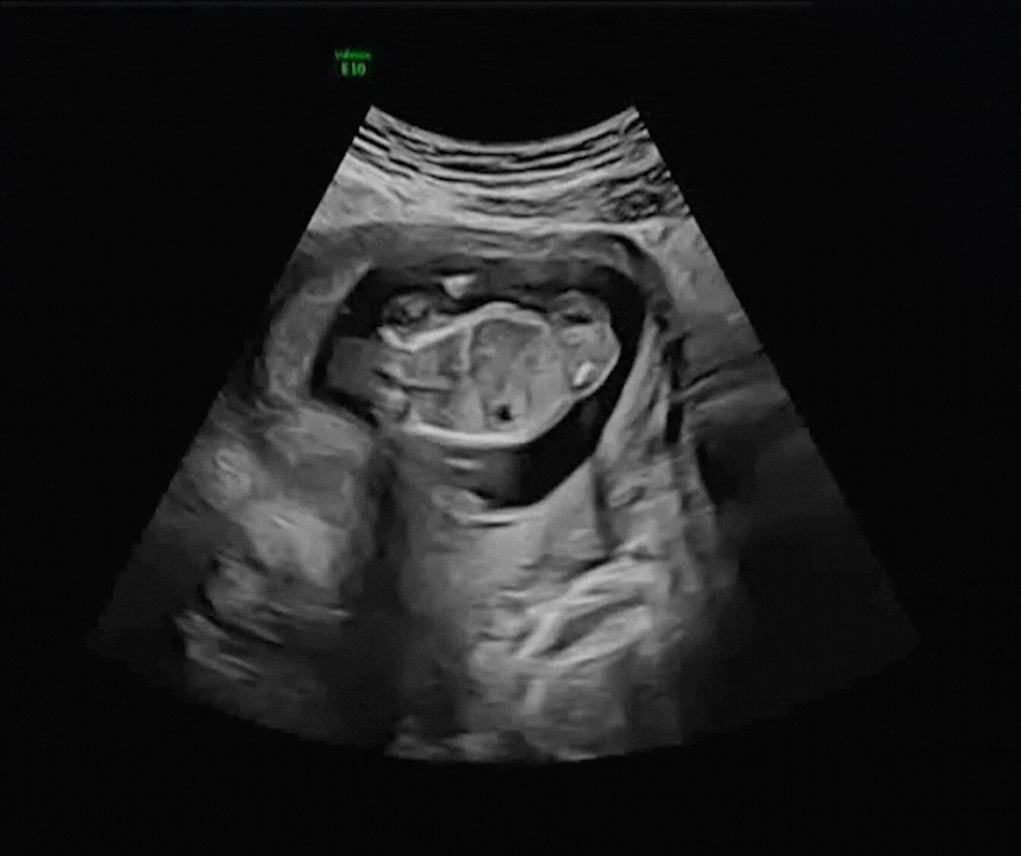 Black and white ultrasound imagery with clear fetus