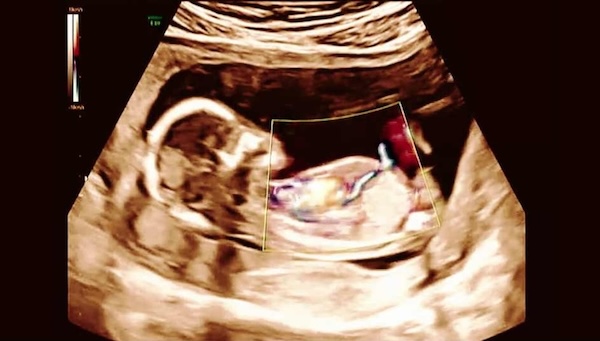 image of an ultrasound with fetus
